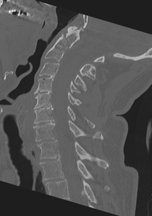 Cervical spine fractures with vertebral artery dissection (Radiopaedia 53296-59268 Sagittal bone window 36).png