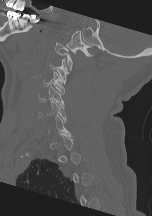 Cervical spine fractures with vertebral artery dissection (Radiopaedia 53296-59268 Sagittal bone window 50).png