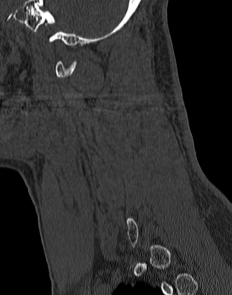 File:Cervical spondylodiscitis (Radiopaedia 28057-29489 Sagittal bone window 18).jpg
