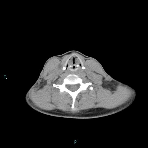 File:Cervical thymic cyst (Radiopaedia 88632-105335 Axial non-contrast 49).jpg