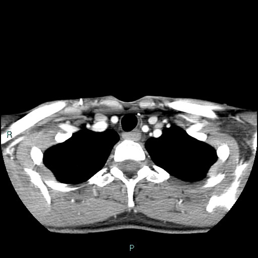 File:Cervical thymic cyst (Radiopaedia 88632-105335 B 27).jpg