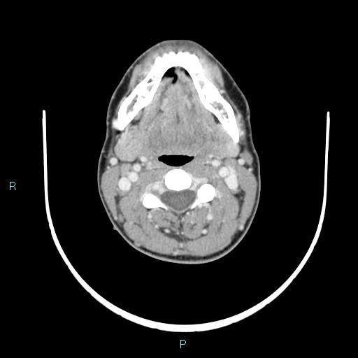 File:Cervical thymic cyst (Radiopaedia 88632-105335 C 75).jpg