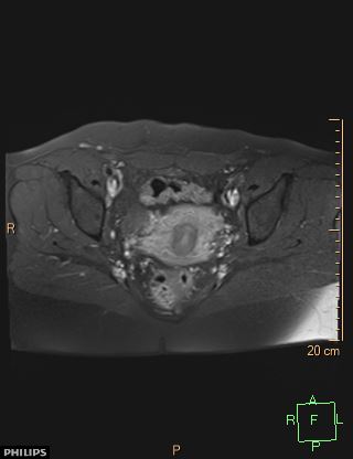 File:Cesarian scar endometriosis (Radiopaedia 68495-78066 Axial T1 C+ fat sat 15).jpg