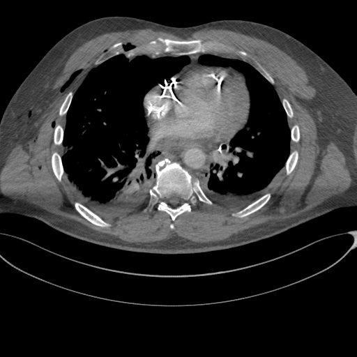 File:Chest multitrauma - aortic injury (Radiopaedia 34708-36147 A 178).png