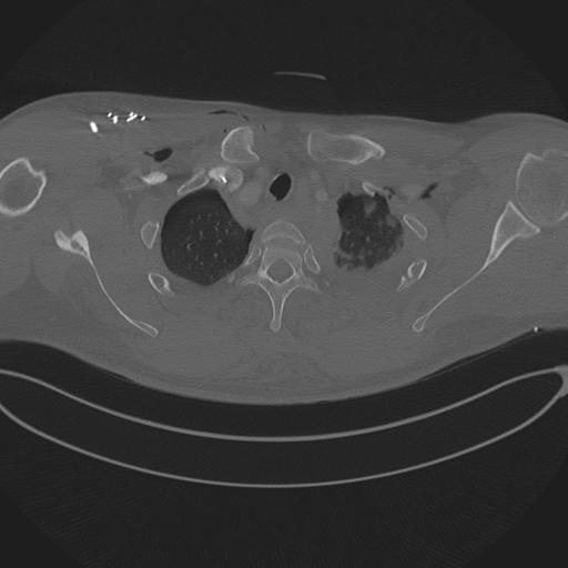 Chest multitrauma - aortic injury (Radiopaedia 34708-36147 Axial bone window 46).png