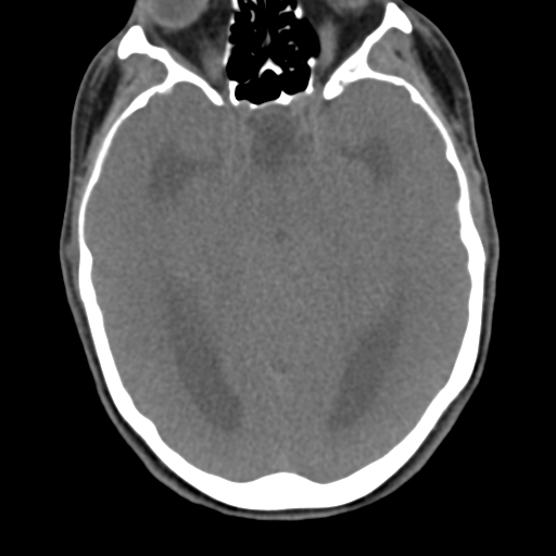 Chiari I malformation and obstructive hydrocephalus (Radiopaedia 41185-43981 D 17).png