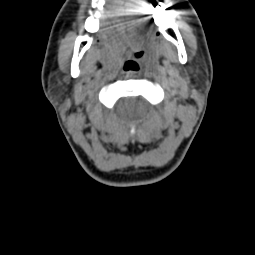File:Chiari I malformation and obstructive hydrocephalus (Radiopaedia 41185-43981 D 38).png