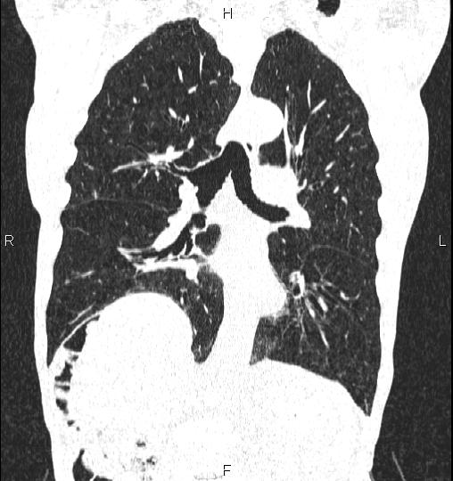 Chilaiditi sign (Radiopaedia 88839-105611 Coronal lung window 36).jpg