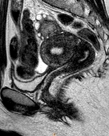 File:Chocolate cysts (endometriomata) (Radiopaedia 25072-25329 Sagittal T2 1).jpg