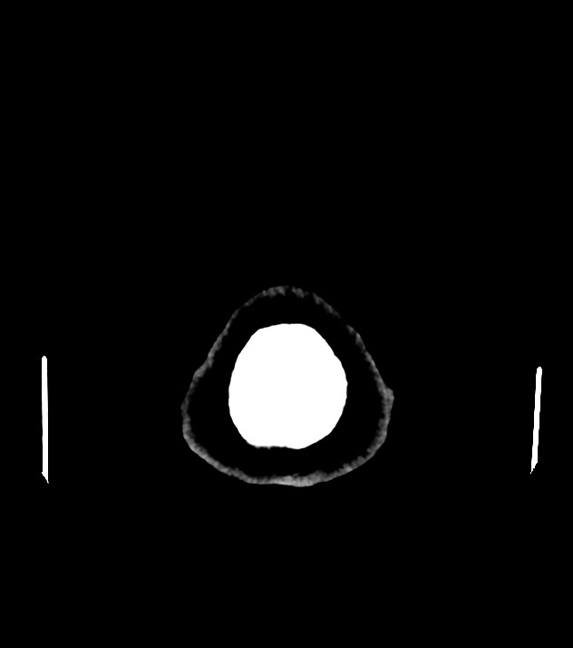 Cholangiocarcinoma with cerebral metastases (Radiopaedia 83519-98628 Axial non-contrast 64).jpg