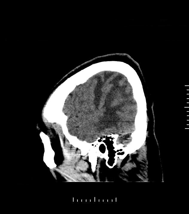 Cholangiocarcinoma with cerebral metastases (Radiopaedia 83519-98628 C 6).jpg