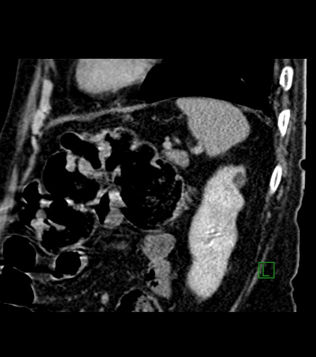 Cholangiocarcinoma with cerebral metastases (Radiopaedia 83519-98629 Sagittal C+ delayed 28).jpg