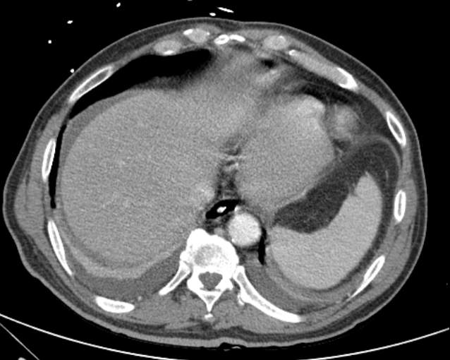 Cholecystitis - perforated gallbladder (Radiopaedia 57038-63916 A 13).jpg