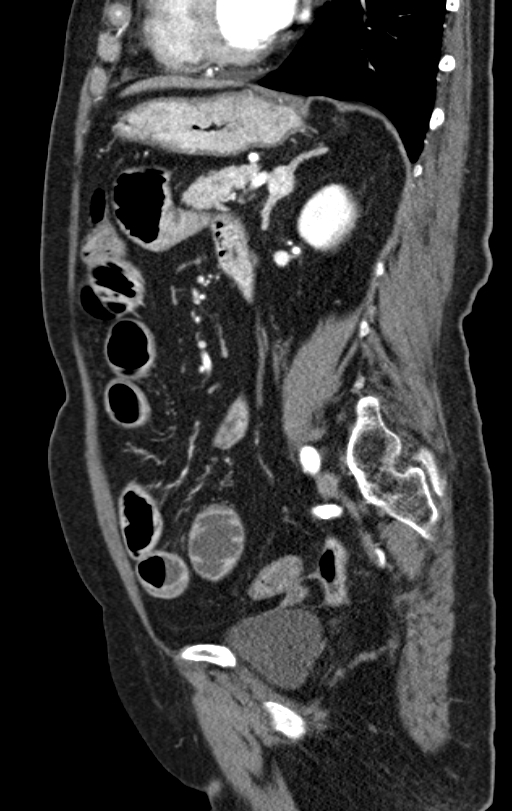 Cholecystoduodenal fistula due to calculous cholecystitis with gallstone migration (Radiopaedia 86875-103077 C 24).jpg
