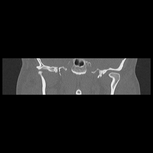 Cholesteatoma (Radiopaedia 84946-100455 Coronal bone window 84).jpg
