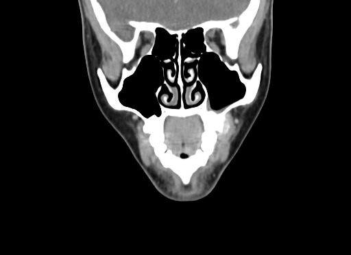 Chondroblastic osteosarcoma (Radiopaedia 67363-76741 D 30).jpg