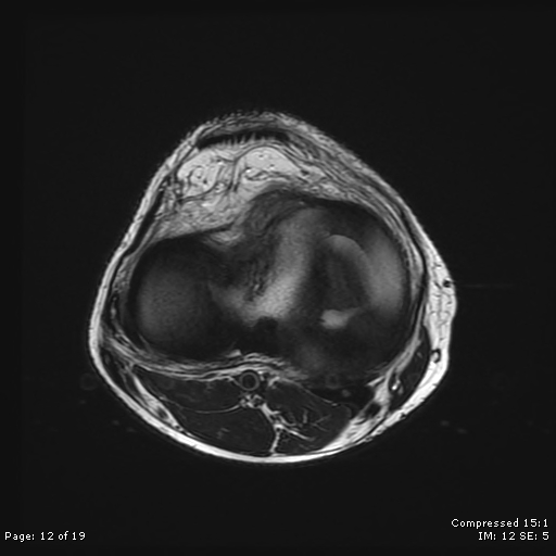 File:Chondroblastoma (Radiopaedia 25725-25891 Axial T2 12).jpg