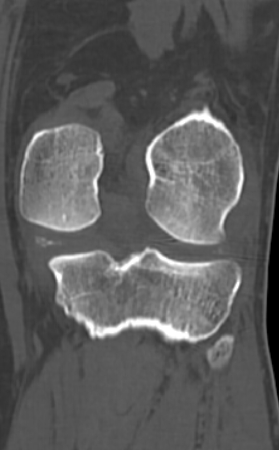Chondrocalcinosis (Radiopaedia 82862-97173 Coronal bone window 54).jpg