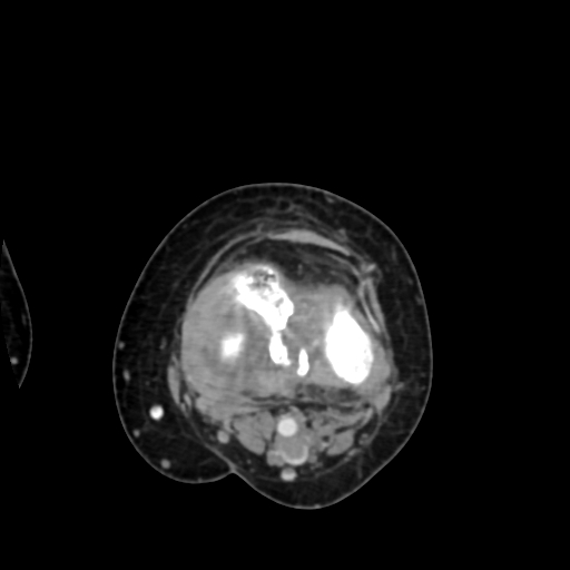 Chondrosarcoma - femur (Radiopaedia 64187-72954 Axial with contrast 56).jpg
