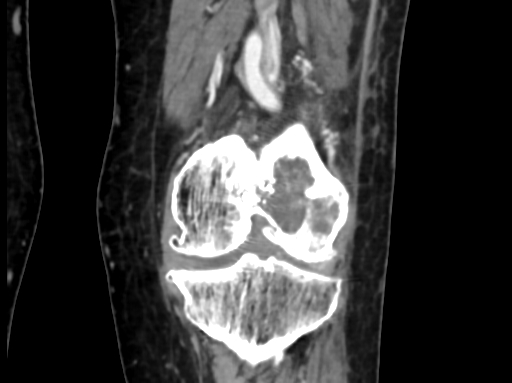 Chondrosarcoma - femur (Radiopaedia 64187-72954 C 35).jpg