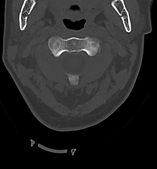 Chordoma (C4 vertebra) (Radiopaedia 47561-52188 Axial bone window 12).png
