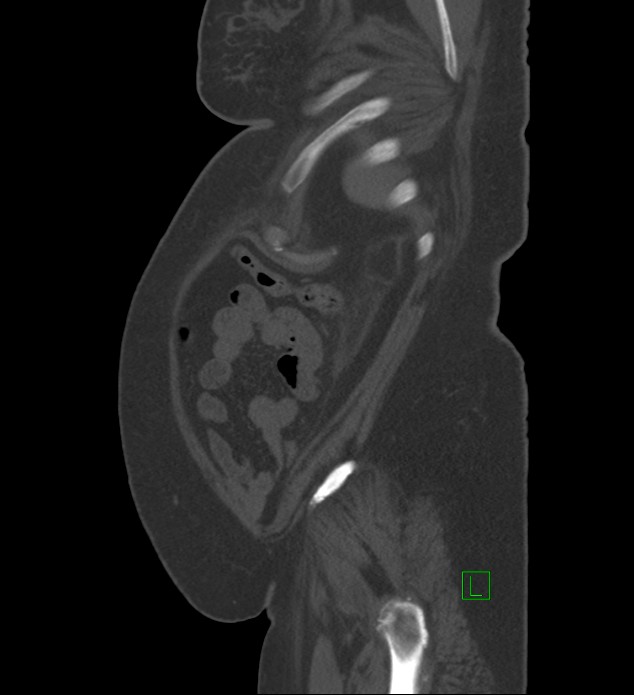 Chromophobe renal cell carcinoma (Radiopaedia 84239-99519 Sagittal bone window 12).jpg