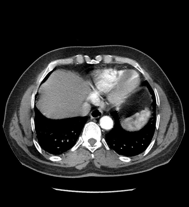 Chromophobe renal cell carcinoma (Radiopaedia 86879-103083 B 13).jpg