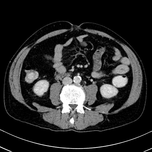 Chronic appendicitis complicated by appendicular abscess, pylephlebitis and liver abscess (Radiopaedia 54483-60700 B 85).jpg