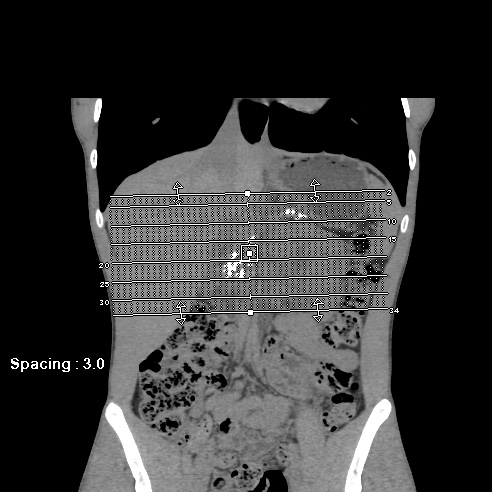 File:Chronic calcific pancreatitis (Radiopaedia 56280-62953 Axial non-contrast 1).jpg