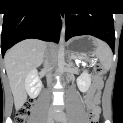 File:Chronic calcific pancreatitis (Radiopaedia 56280-62953 F 15).jpg