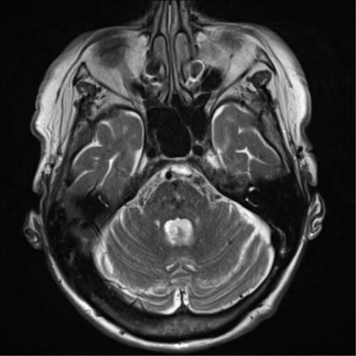 File:Chronic hypertensive encephalopathy (Radiopaedia 72844-83495 Axial T2 10).png