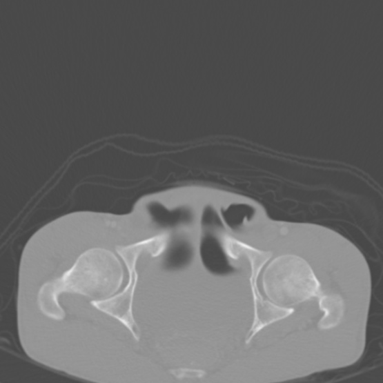 Chronic large bowel pseudo-obstruction (Radiopaedia 43181-46492 Axial bone window 157).jpg