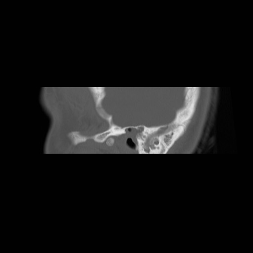 File:Chronic otomastoiditis (Radiopaedia 27138-27309 Sagittal bone window 2).jpg