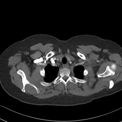 File:Chronic pulmonary embolus (Radiopaedia 39129-41341 Axial C+ CTPA 13).png