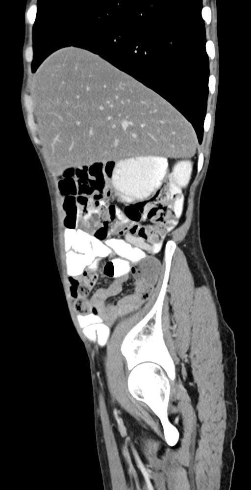 Chronic small bowel volvulus (Radiopaedia 75224-86322 C 115).jpg
