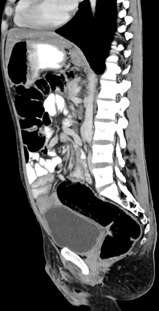 Chronic small bowel volvulus (Radiopaedia 75224-86322 C 68).jpg