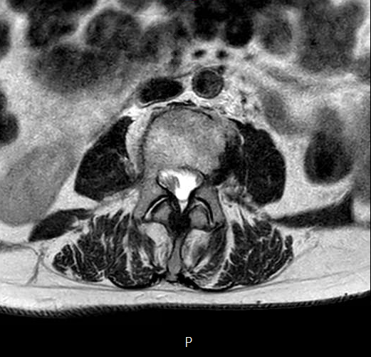 File:Chronic spinal hematoma with cauda equina syndrome (Radiopaedia 75745-87090 Axial T2 6).png