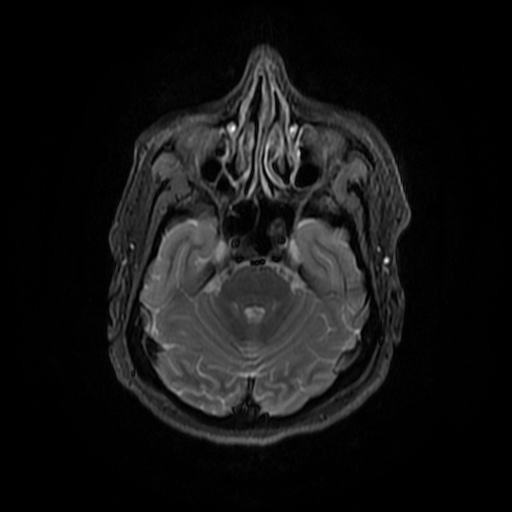 File:Chronic submandibular sialadenitis (Radiopaedia 61852-69885 Axial STIR 2).jpg