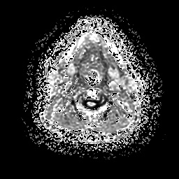 File:Chronic submandibular sialadenitis (Radiopaedia 61852-69885 Axial eADC 14).jpg