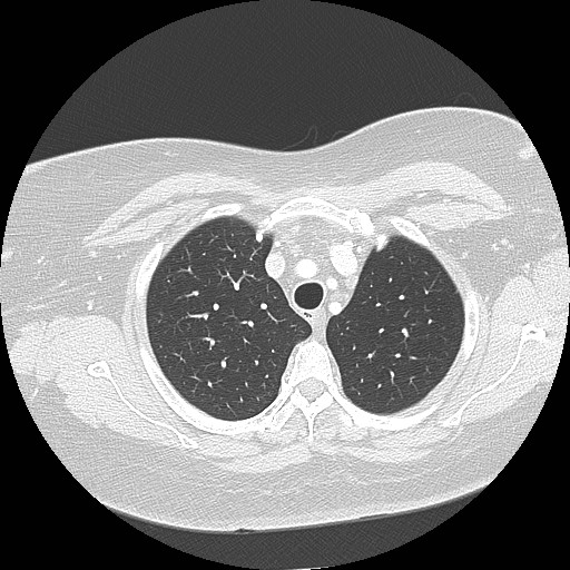 File:Cicatrisation collapse (Radiopaedia 17405-17089 lung window 24).jpg