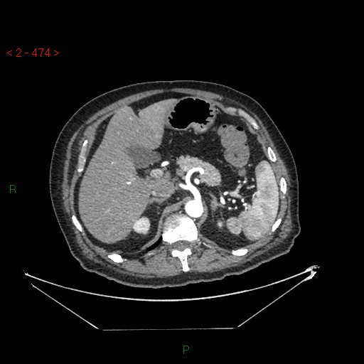 Circumaortic left renal vein and doubled left renal arteries (Radiopaedia 52268-58158 A 10).jpg