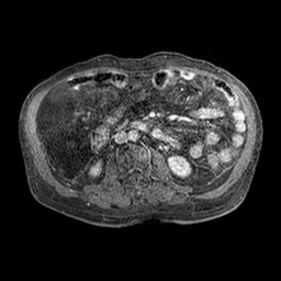 File:Cirrhosis and hepatocellular carcinoma in the setting of hemochromatosis (Radiopaedia 75394-86594 Axial T1 C+ fat sat 265).jpg