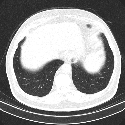 Classic complicated silicosis (Radiopaedia 49720-54961 Axial lung window 50).jpg