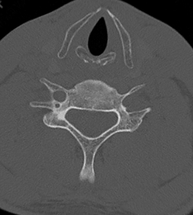 Clay-shoveler fracture (Radiopaedia 14604-14532 Axial bone window 1).jpg