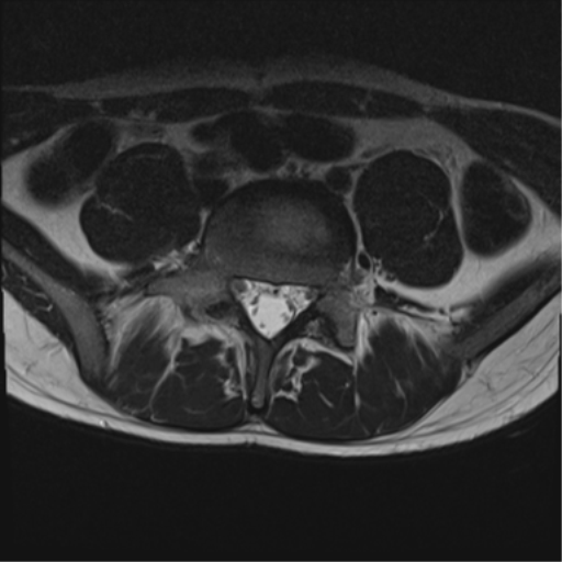 File:Clear cell meningoma - lumbar spine (Radiopaedia 60116-67690 Axial T2 10).png