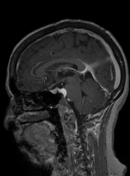 File:Clival meningioma (Radiopaedia 53278-59248 Sagittal T1 C+ 262).jpg