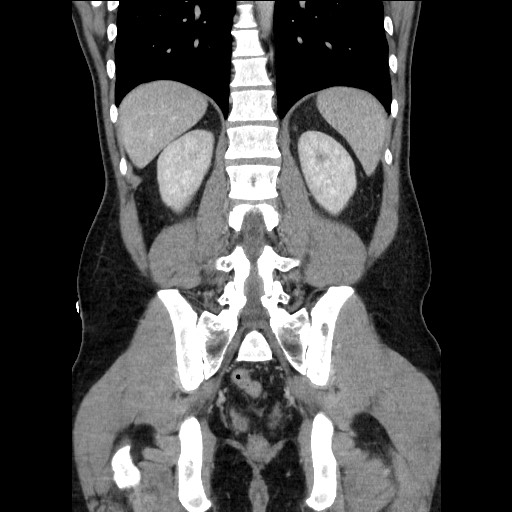 Closed-loop small bowel obstruction (Radiopaedia 73713-84509 C 90).jpg