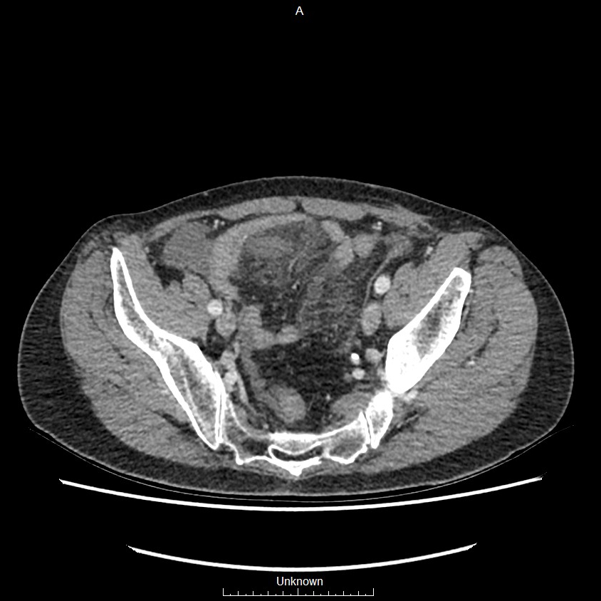 Closed loop bowel obstruction and ischemia (Radiopaedia 86959-103180 A 72).jpg