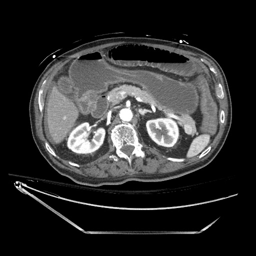 File:Closed loop obstruction due to adhesive band, resulting in small bowel ischemia and resection (Radiopaedia 83835-99023 Axial 283).jpg
