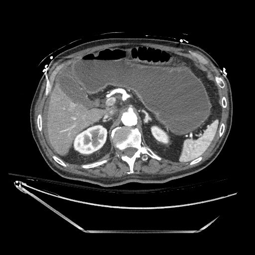 File:Closed loop obstruction due to adhesive band, resulting in small bowel ischemia and resection (Radiopaedia 83835-99023 B 45).jpg